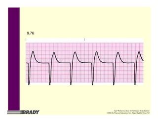 9.76
Gail Walraven, Basic Arrhythmias, Sixth Edition
©2006 by Pearson Education, Inc., Upper Saddle River, NJ
 
