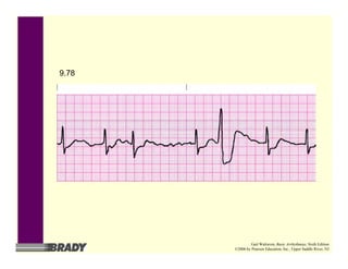 9.78
Gail Walraven, Basic Arrhythmias, Sixth Edition
©2006 by Pearson Education, Inc., Upper Saddle River, NJ
 