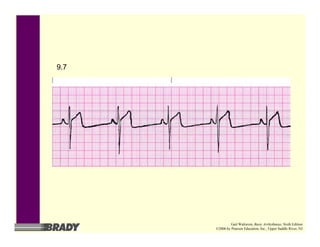 9.7
Gail Walraven, Basic Arrhythmias, Sixth Edition
©2006 by Pearson Education, Inc., Upper Saddle River, NJ
 