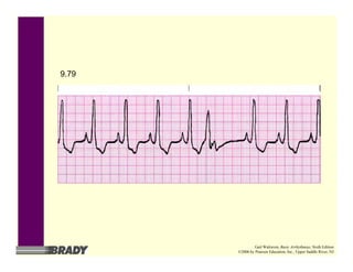 9.79
Gail Walraven, Basic Arrhythmias, Sixth Edition
©2006 by Pearson Education, Inc., Upper Saddle River, NJ
 