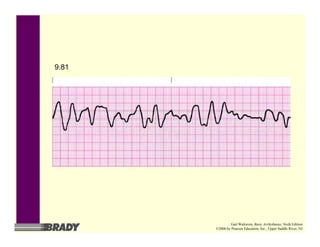 9.81
Gail Walraven, Basic Arrhythmias, Sixth Edition
©2006 by Pearson Education, Inc., Upper Saddle River, NJ
 