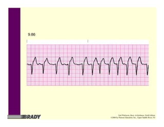 9.86
Gail Walraven, Basic Arrhythmias, Sixth Edition
©2006 by Pearson Education, Inc., Upper Saddle River, NJ
 