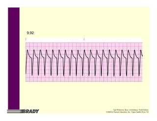 9.92
Gail Walraven, Basic Arrhythmias, Sixth Edition
©2006 by Pearson Education, Inc., Upper Saddle River, NJ
 