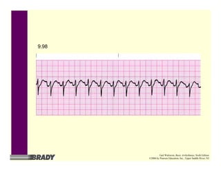 9.98
Gail Walraven, Basic Arrhythmias, Sixth Edition
©2006 by Pearson Education, Inc., Upper Saddle River, NJ
 