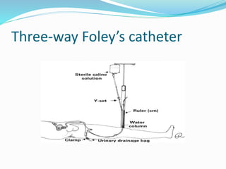 Three-way Foley’s catheter
 