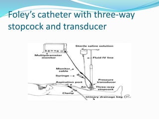Foley’s catheter with three-way
stopcock and transducer
 