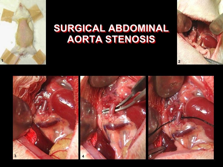 blood 24 pressure test hours an localizing in essential Turbulent role plays blood flow