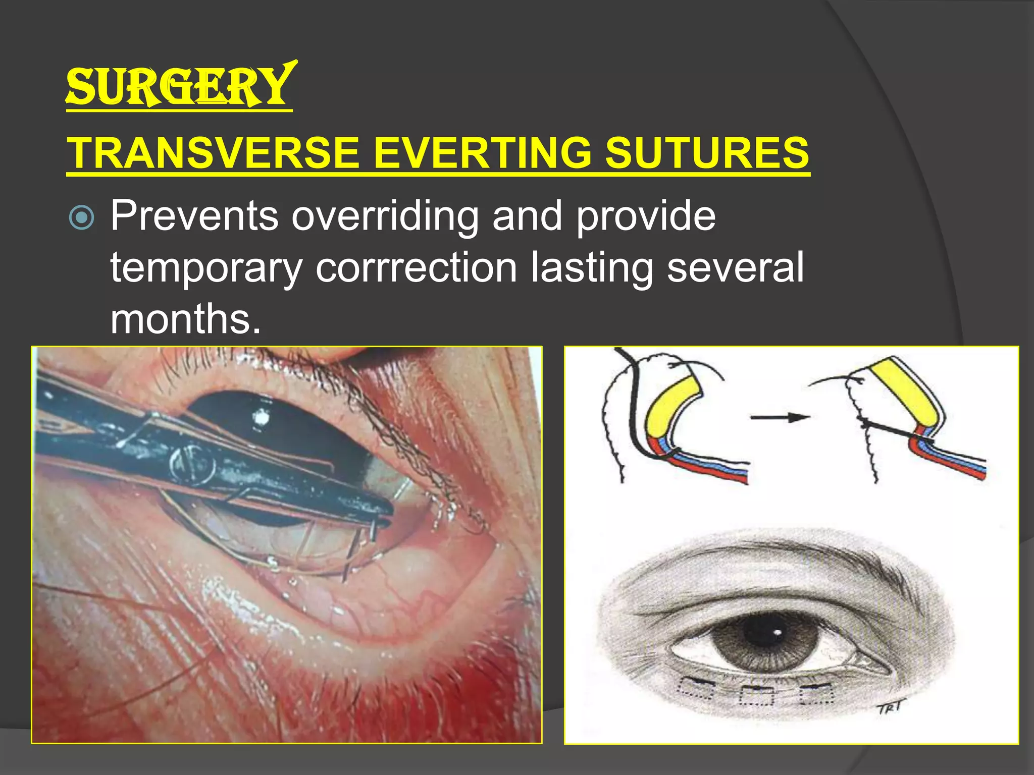 SURGERY
TRANSVERSE EVERTING SUTURES
 Prevents overriding and provide
temporary corrrection lasting several
months.
 