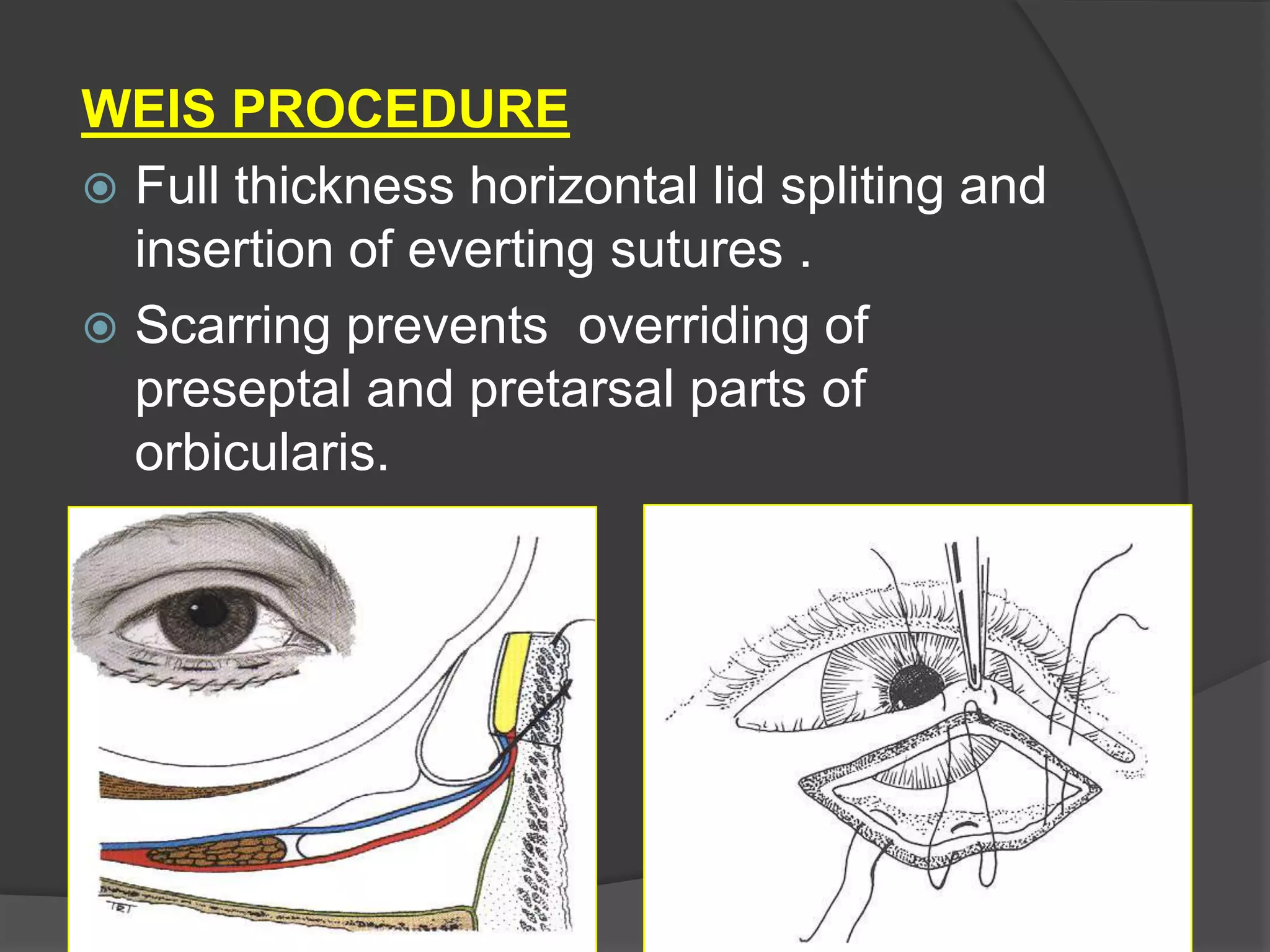 WEIS PROCEDURE
 Full thickness horizontal lid spliting and
insertion of everting sutures .
 Scarring prevents overriding of
preseptal and pretarsal parts of
orbicularis.
 