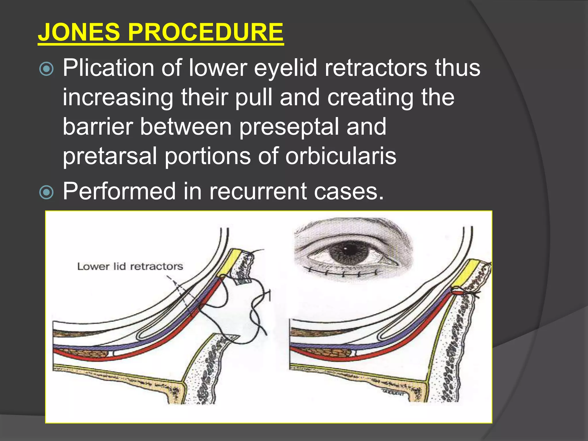 JONES PROCEDURE
 Plication of lower eyelid retractors thus
increasing their pull and creating the
barrier between preseptal and
pretarsal portions of orbicularis
 Performed in recurrent cases.
 