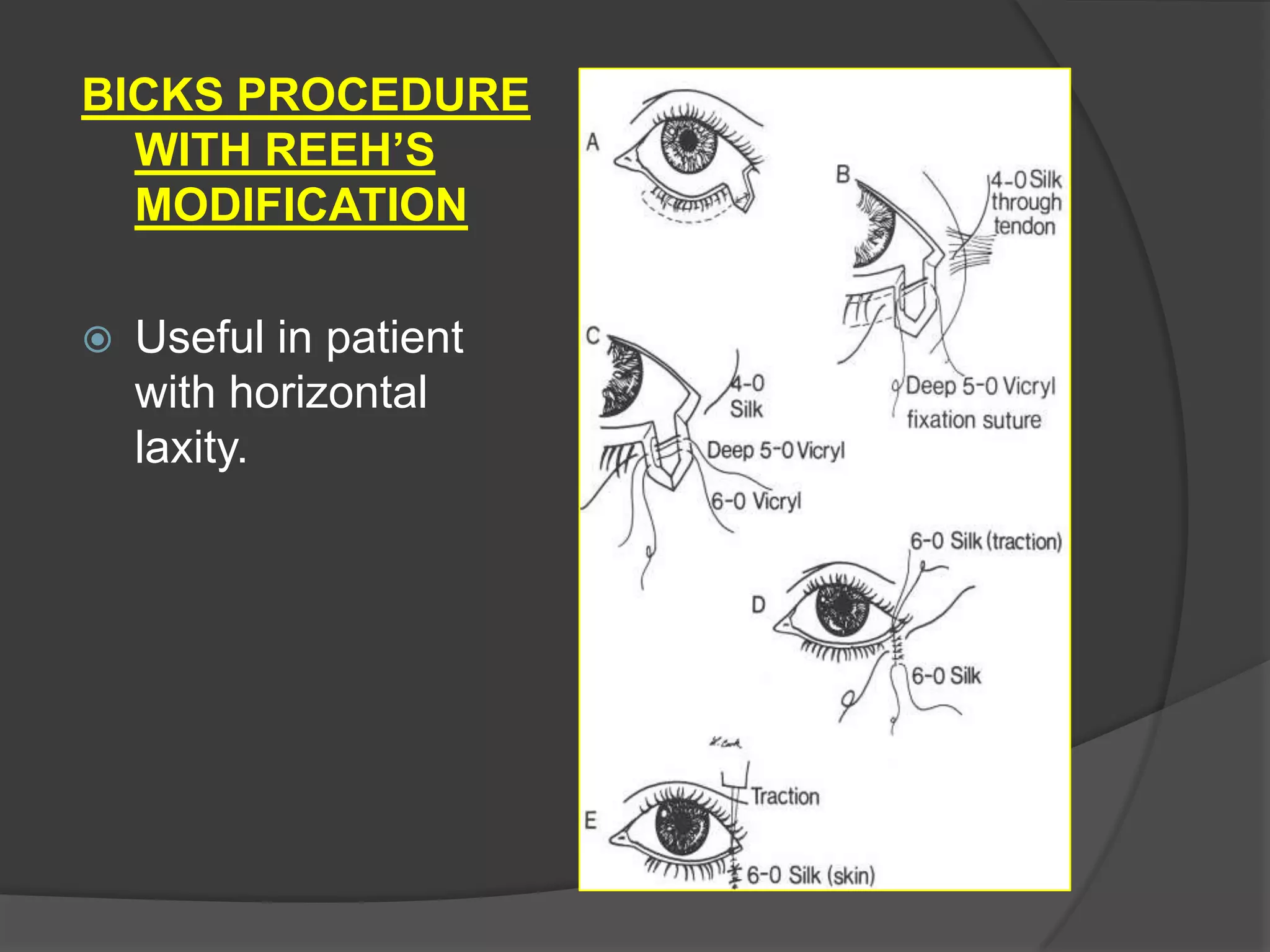 BICKS PROCEDURE
WITH REEH’S
MODIFICATION
 Useful in patient
with horizontal
laxity.
 
