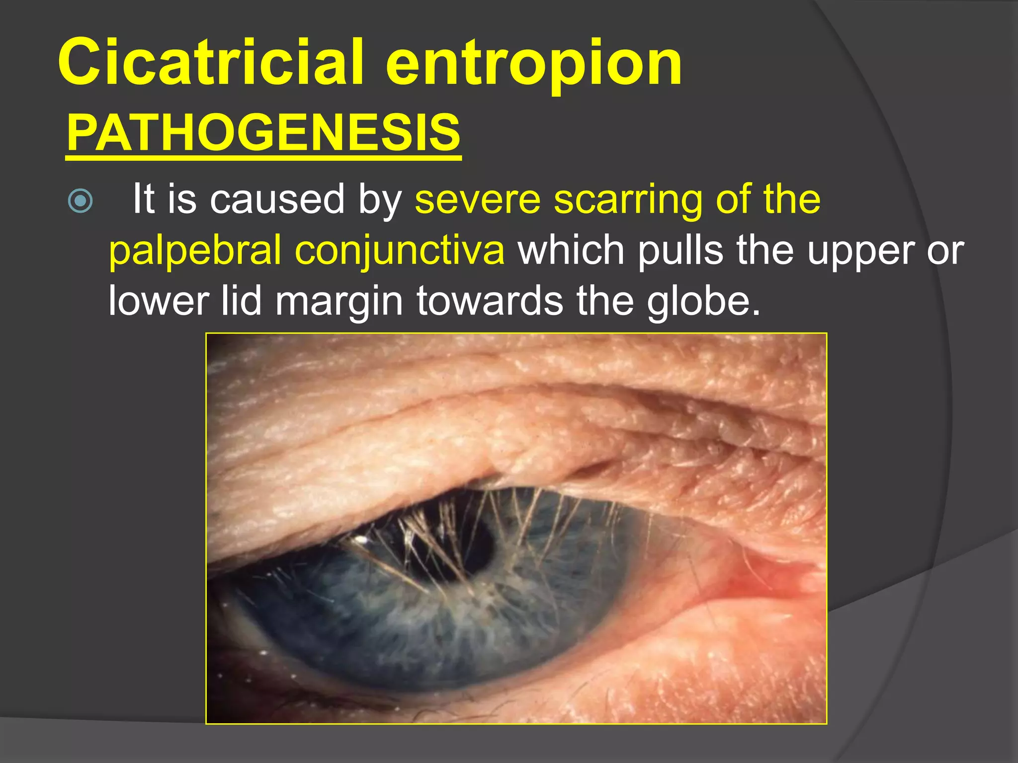 Cicatricial entropion
PATHOGENESIS
 It is caused by severe scarring of the
palpebral conjunctiva which pulls the upper or
lower lid margin towards the globe.
 