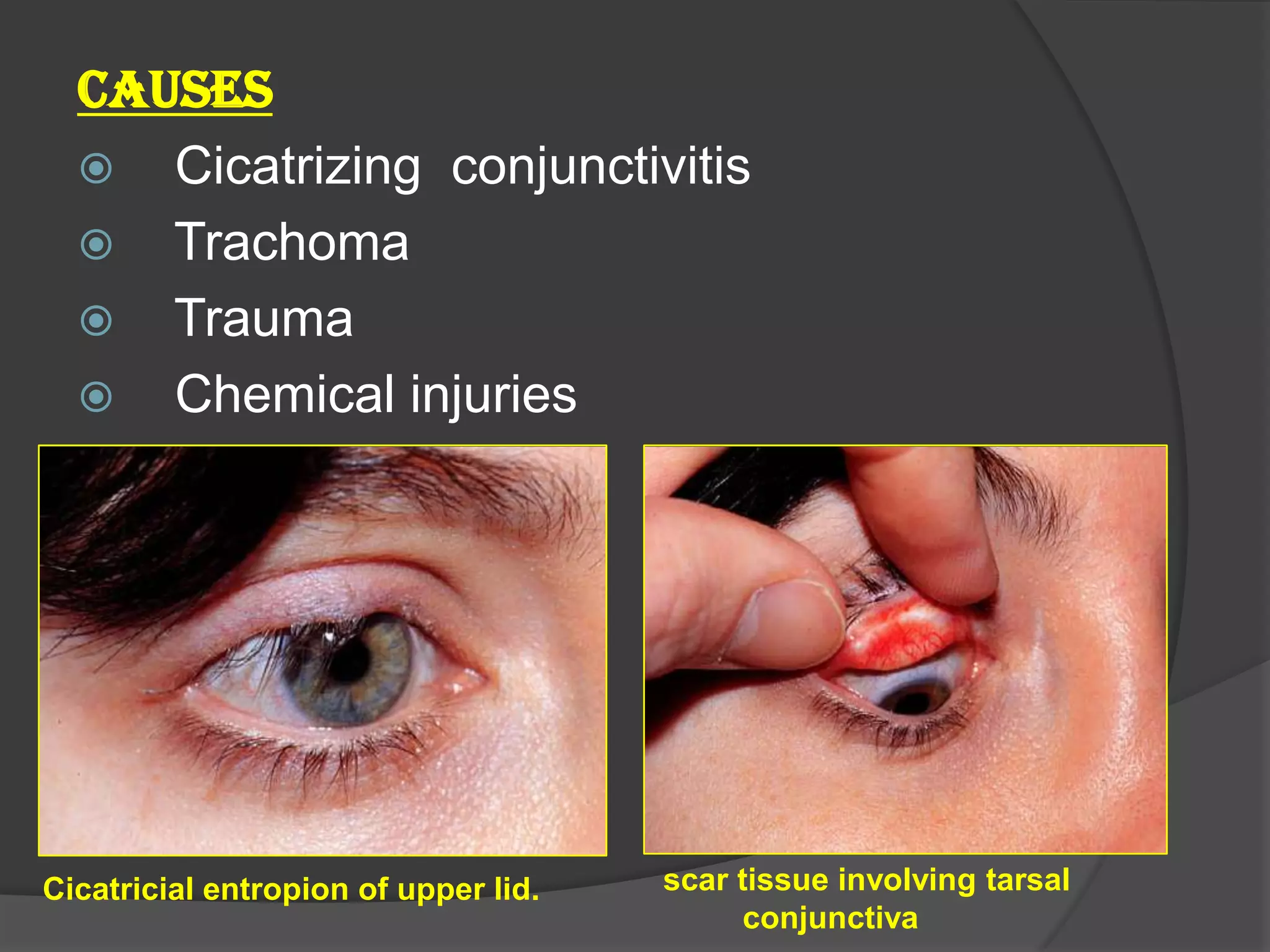 CAUSES
 Cicatrizing conjunctivitis
 Trachoma
 Trauma
 Chemical injuries
Cicatricial entropion of upper lid. scar tissue involving tarsal
conjunctiva
 
