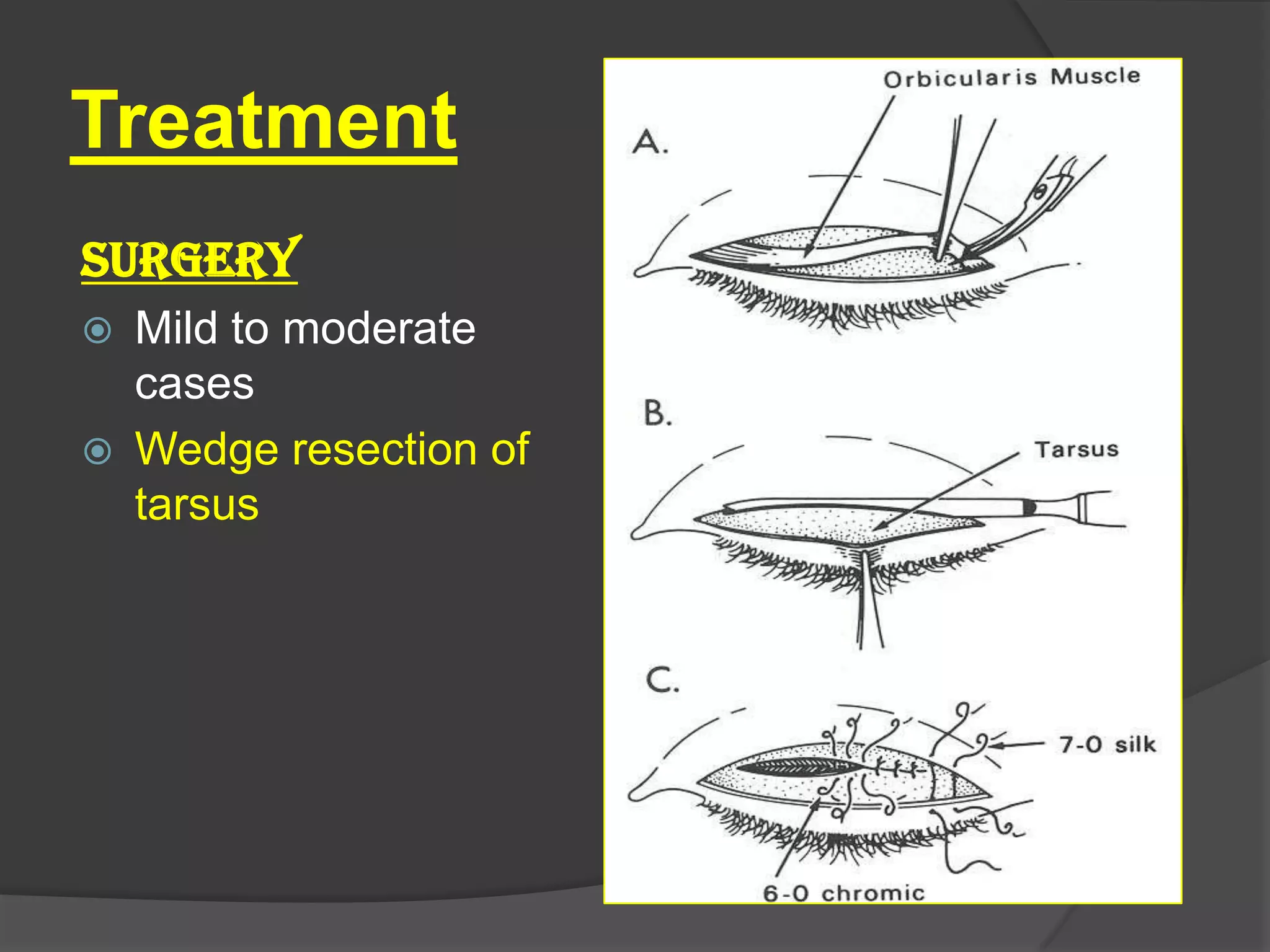 Treatment
SURGERY
 Mild to moderate
cases
 Wedge resection of
tarsus
 
