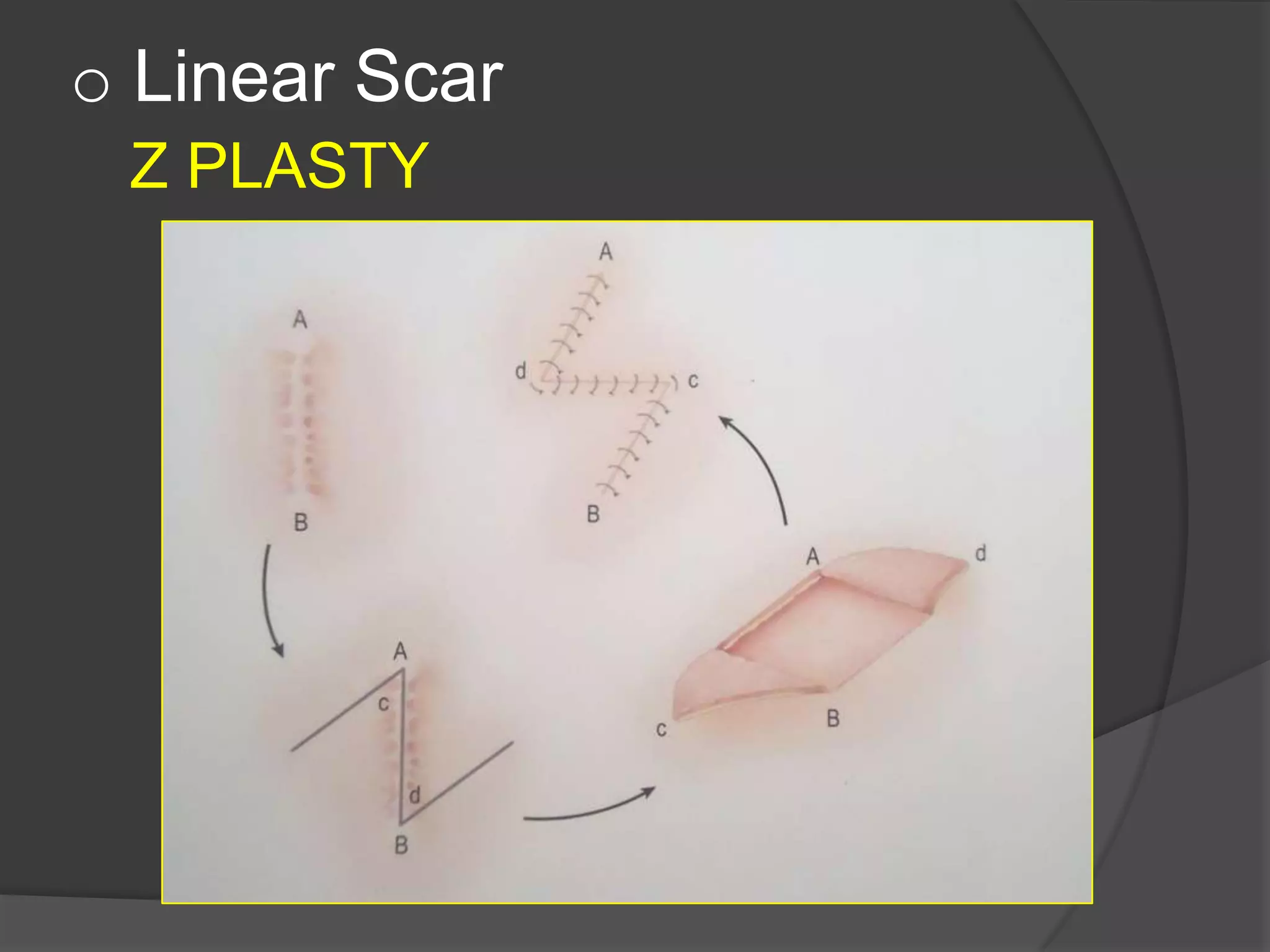 o Linear Scar
Z PLASTY
 