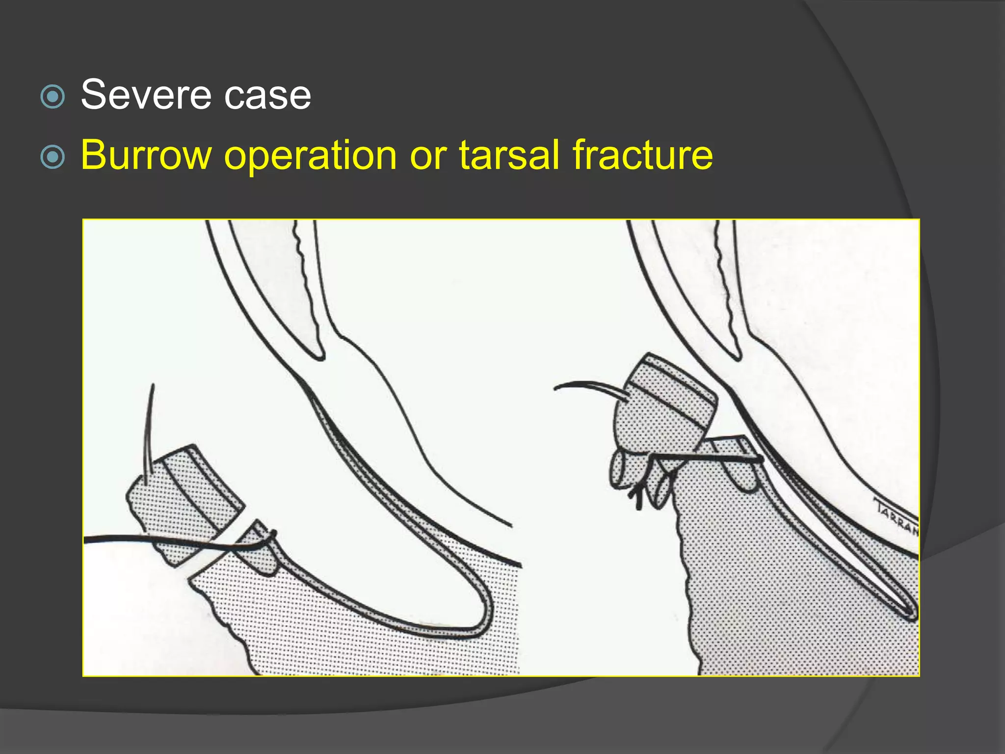  Severe case
 Burrow operation or tarsal fracture
 