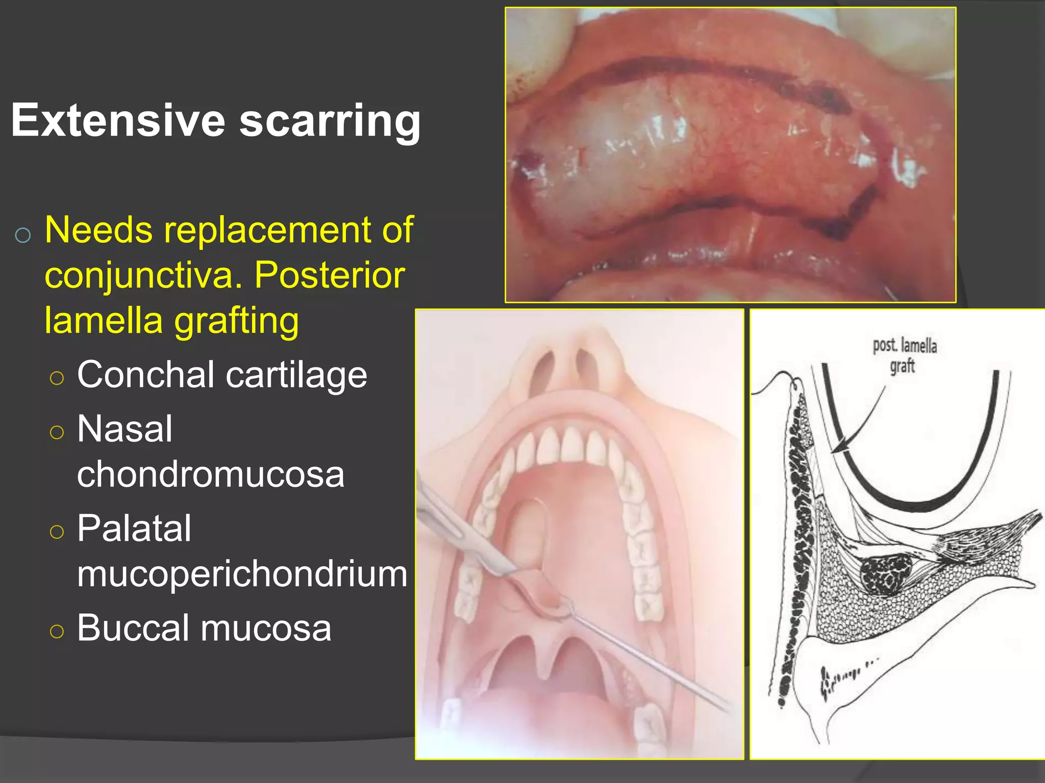 Extensive scarring
o Needs replacement of
conjunctiva. Posterior
lamella grafting
○ Conchal cartilage
○ Nasal
chondromucosa
○ Palatal
mucoperichondrium
○ Buccal mucosa
 
