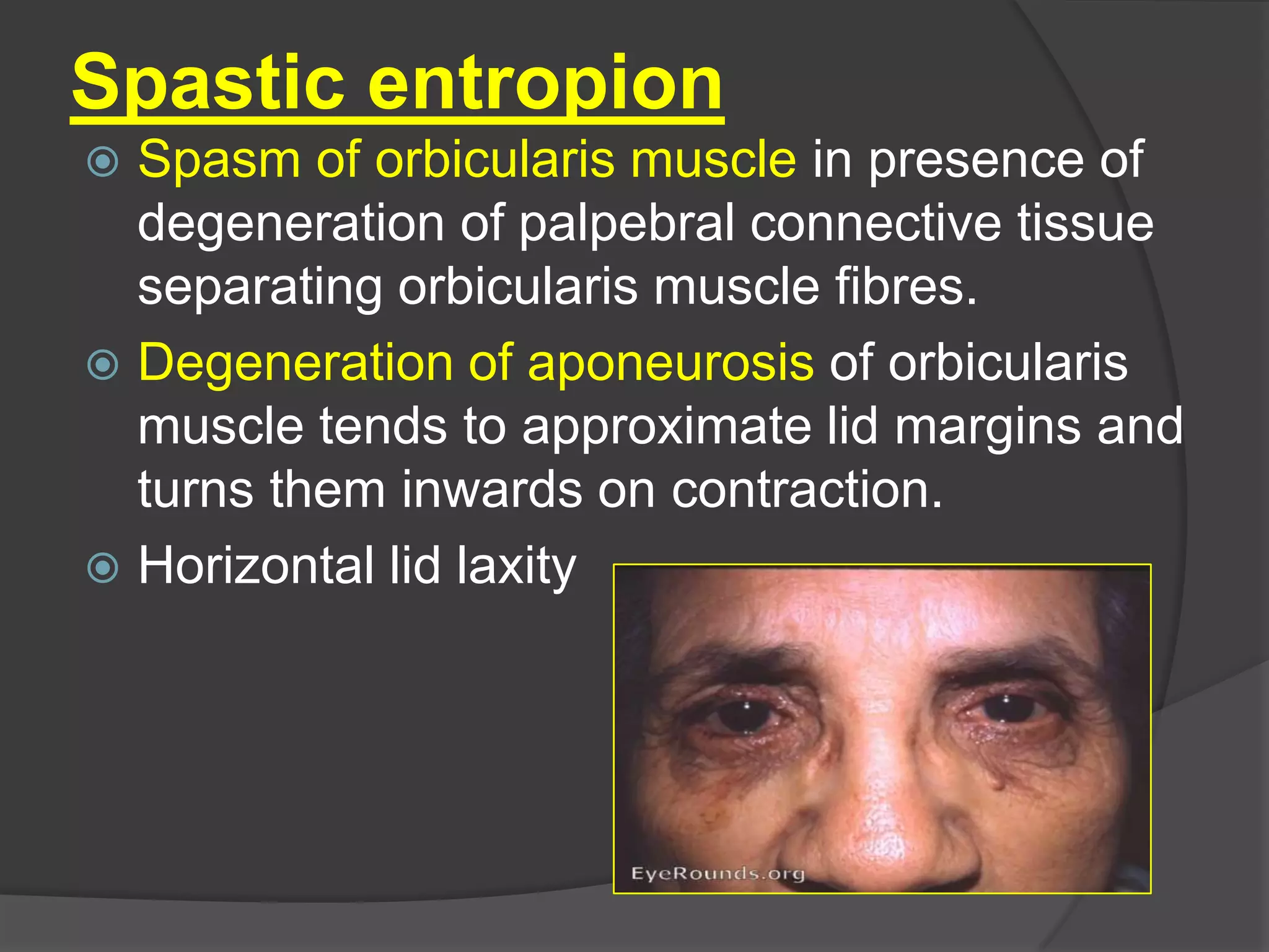 Spastic entropion
 Spasm of orbicularis muscle in presence of
degeneration of palpebral connective tissue
separating orbicularis muscle fibres.
 Degeneration of aponeurosis of orbicularis
muscle tends to approximate lid margins and
turns them inwards on contraction.
 Horizontal lid laxity
 