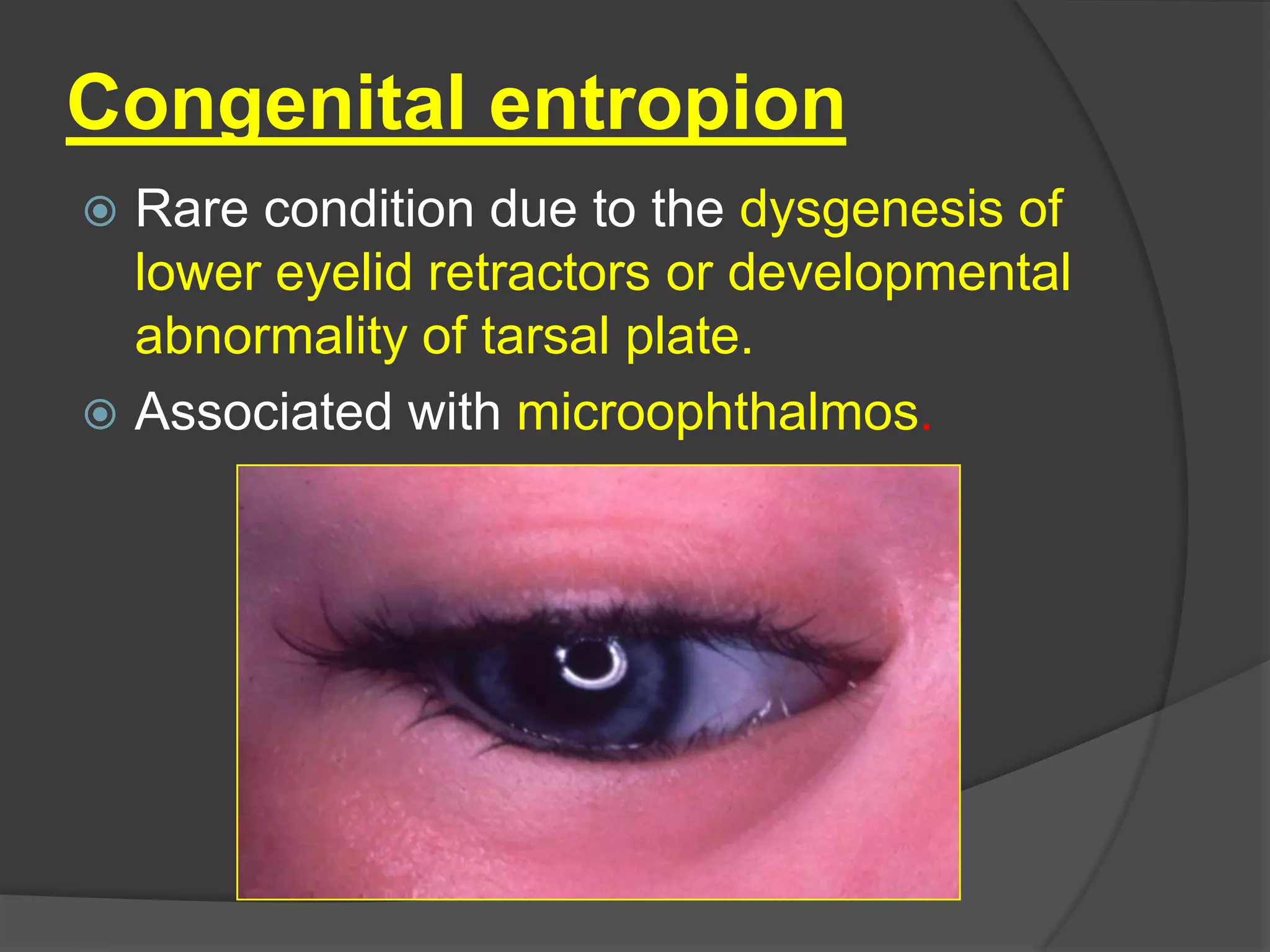Congenital entropion
 Rare condition due to the dysgenesis of
lower eyelid retractors or developmental
abnormality of tarsal plate.
 Associated with microophthalmos.
 