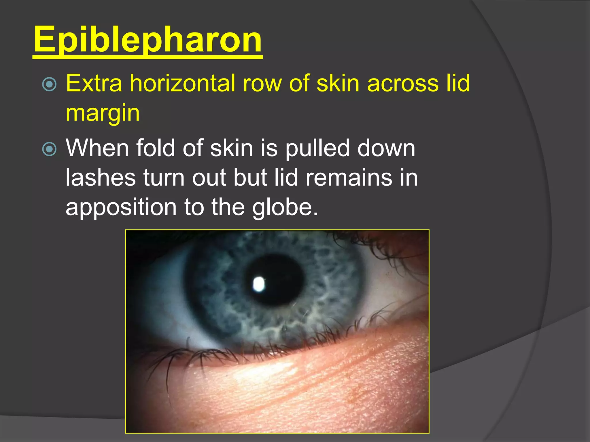 Epiblepharon
 Extra horizontal row of skin across lid
margin
 When fold of skin is pulled down
lashes turn out but lid remains in
apposition to the globe.
 