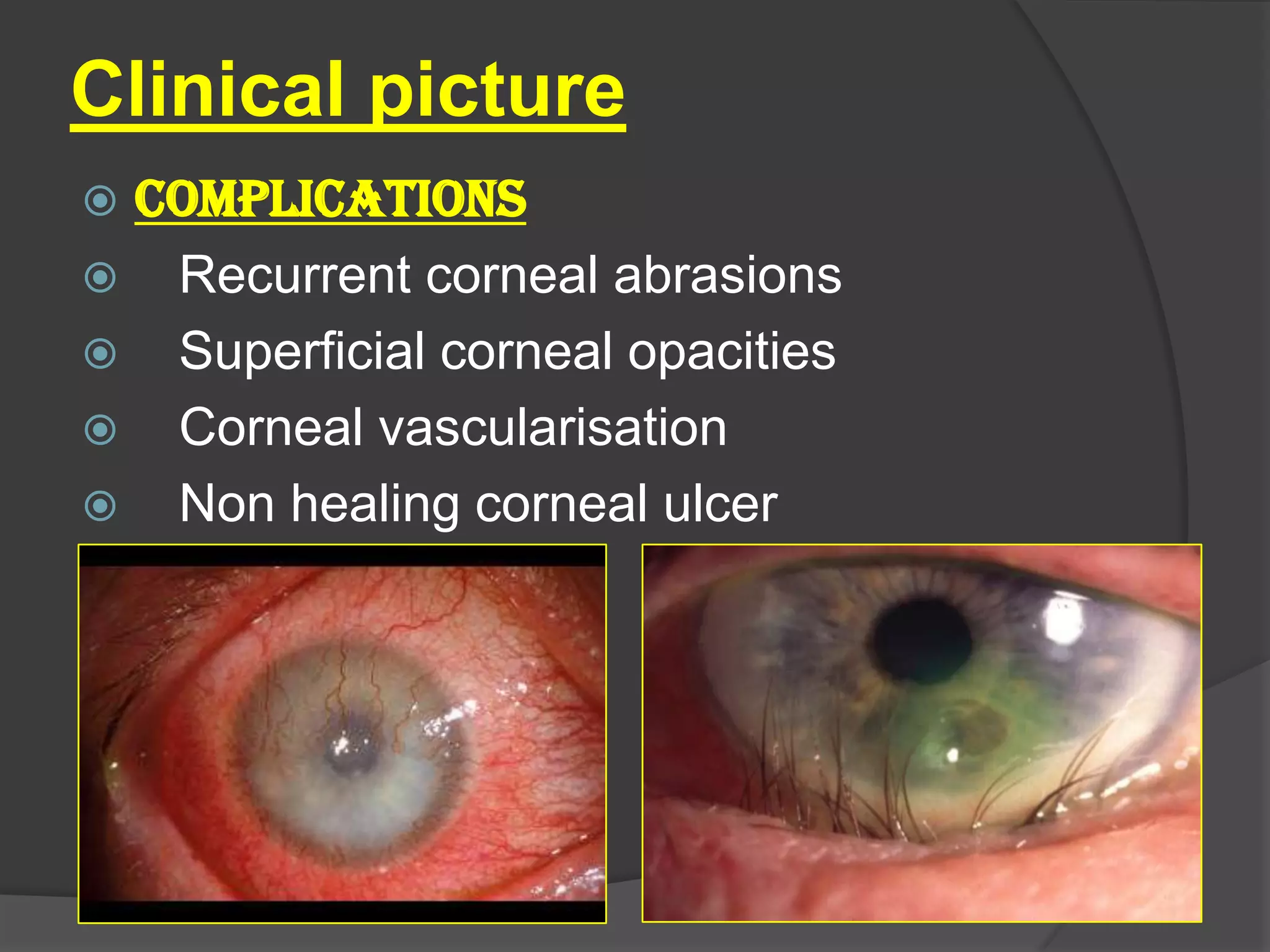 Clinical picture
 COMPLICATIONS
 Recurrent corneal abrasions
 Superficial corneal opacities
 Corneal vascularisation
 Non healing corneal ulcer
 