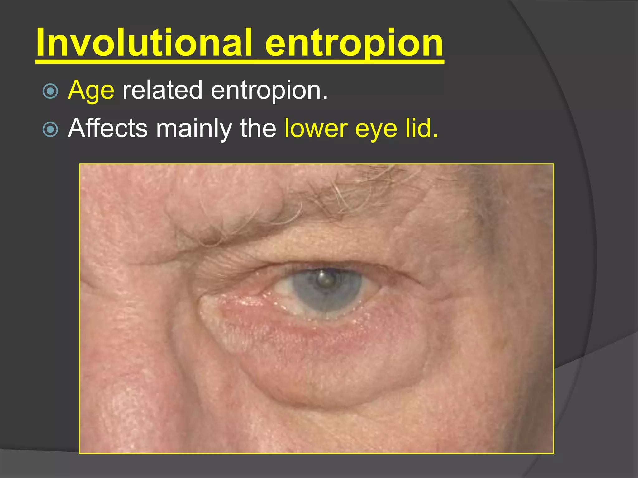 Involutional entropion
 Age related entropion.
 Affects mainly the lower eye lid.
 