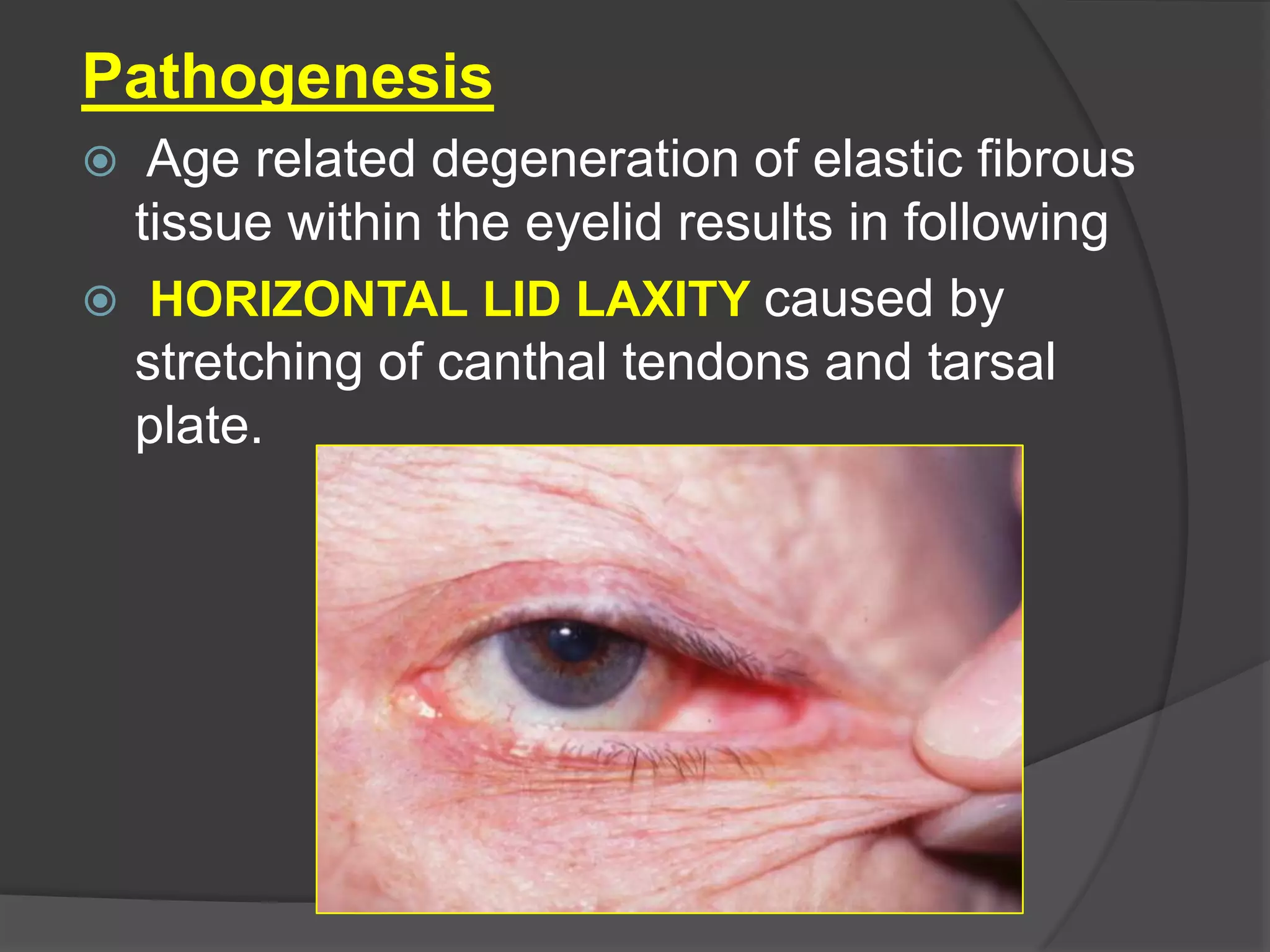 Pathogenesis
 Age related degeneration of elastic fibrous
tissue within the eyelid results in following
 HORIZONTAL LID LAXITY caused by
stretching of canthal tendons and tarsal
plate.
 