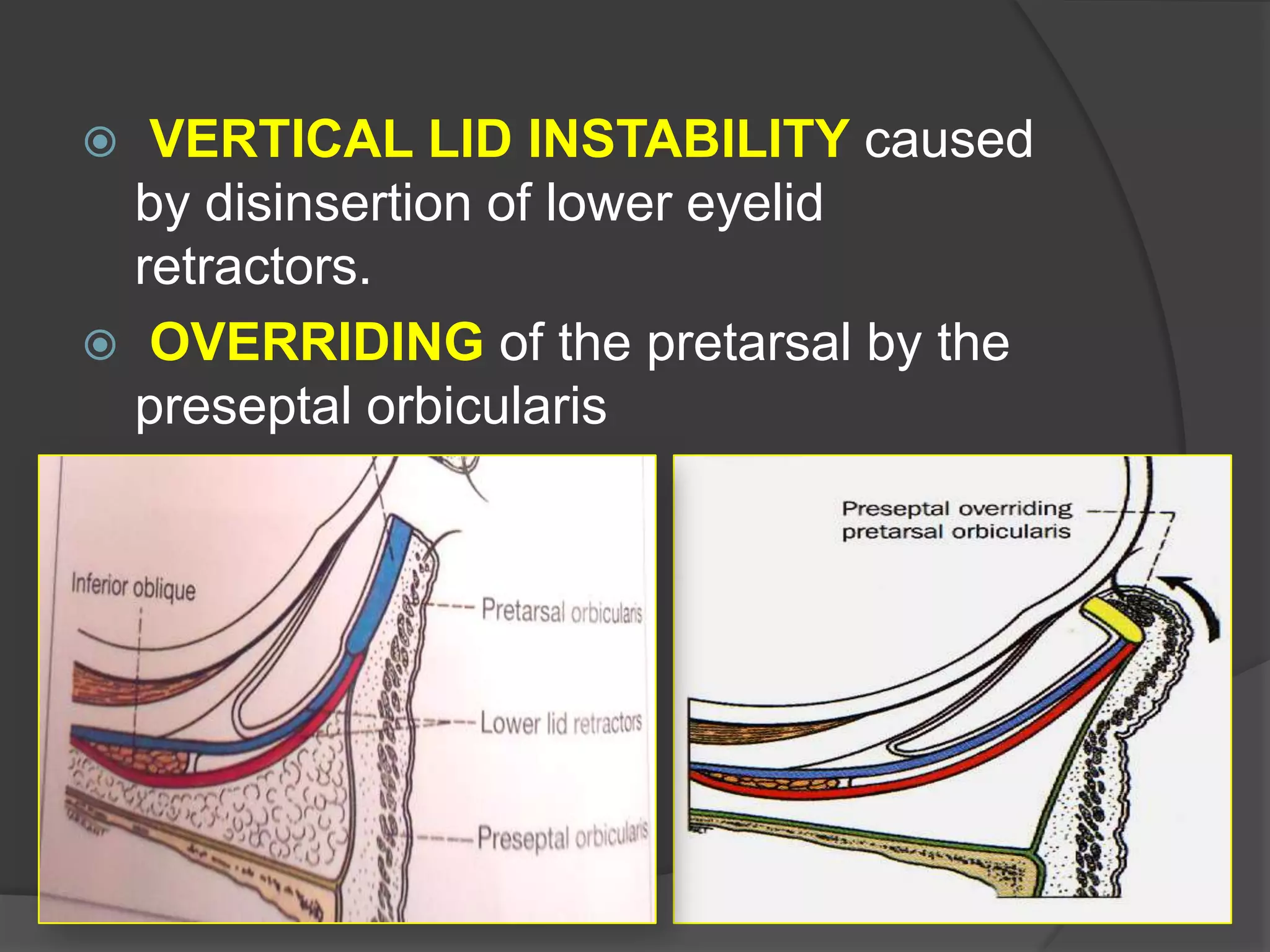 VERTICAL LID INSTABILITY caused
by disinsertion of lower eyelid
retractors.
 OVERRIDING of the pretarsal by the
preseptal orbicularis
 