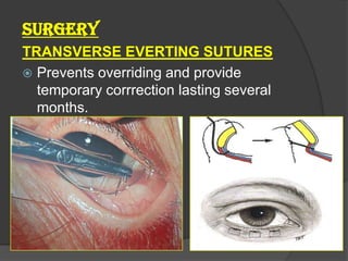 SURGERY
TRANSVERSE EVERTING SUTURES
 Prevents overriding and provide
temporary corrrection lasting several
months.
 