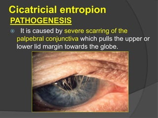 Cicatricial entropion
PATHOGENESIS
 It is caused by severe scarring of the
palpebral conjunctiva which pulls the upper or
lower lid margin towards the globe.
 
