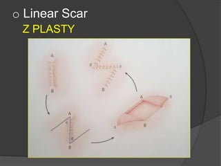 o Linear Scar
Z PLASTY
 