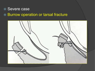  Severe case
 Burrow operation or tarsal fracture
 