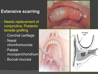 Extensive scarring
o Needs replacement of
conjunctiva. Posterior
lamella grafting
○ Conchal cartilage
○ Nasal
chondromucosa
○ Palatal
mucoperichondrium
○ Buccal mucosa
 