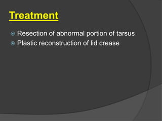 Treatment
 Resection of abnormal portion of tarsus
 Plastic reconstruction of lid crease
 