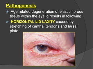 Pathogenesis
 Age related degeneration of elastic fibrous
tissue within the eyelid results in following
 HORIZONTAL LID LAXITY caused by
stretching of canthal tendons and tarsal
plate.
 
