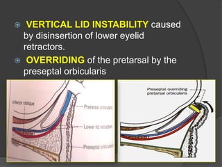  VERTICAL LID INSTABILITY caused
by disinsertion of lower eyelid
retractors.
 OVERRIDING of the pretarsal by the
preseptal orbicularis
 