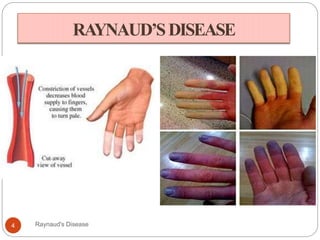 RAYNAUD’SDISEASE
4 Raynaud's Disease
 