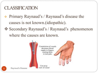 CLASSIFICATION
 Primary Raynaud’s / Raynaud’s disease the
causes is not known.(idiopathic).
 Secondary Raynaud’s / Raynaud’s phenomenon
where the causes are known.
5 Raynaud's Disease
 