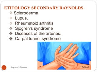 ETITOLOGY SECONDARY RAYNOLDS
 Scleroderma
 Lupus.
 Rheumatoid arthritis
 Sjogren's syndrome
 Diseases of the arteries.
 Carpal tunnel syndrome
7 Raynaud's Disease
 