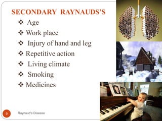 n
SECONDARY RAYNAUDS’S
 Age
 Work place
 Injury of hand and leg
 Repetitive action
 Living climate
 Smoking
 Medicines
9 Raynaud's Disease
 