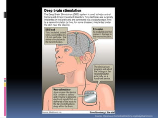 Sources http://www.themedicaldirectory.org/essays/parkinsons
 