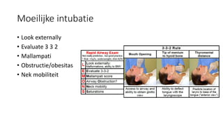 Moeilijke intubatie
• Look externally
• Evaluate 3 3 2
• Mallampati
• Obstructie/obesitas
• Nek mobiliteit
 
