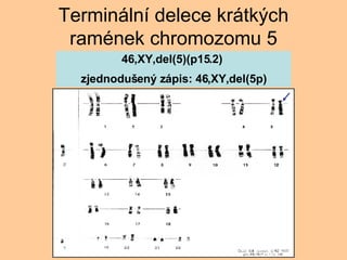 Terminln delece krtk?ch ramnek chromozomu 5 46,XY,del(5)(p15.2)  zjednodu?en? zpis: 46,XY,del(5p) 