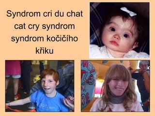 Syndrom cri du chat cat cry syndrom syndrom ko?i?ho k?iku 