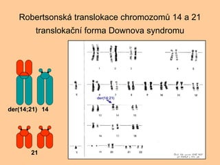 Robertsonsk translokace chromozom? 14 a 21 transloka?n forma Downova syndromu 21 14 der(14;21) der(14;21) 