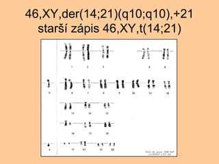 46,XY,der(14;21)(q10;q10),+21 star? zpis 46,XY,t(14;21) 
