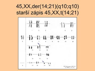 45,XX,der(14;21)(q10;q10) star? zpis 45,XX,t(14;21) 