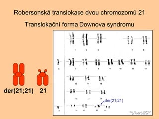 Robersonsk translokace dvou chromozom? 21 Transloka?n forma Downova syndromu der(21;21) 21 der(21;21) 