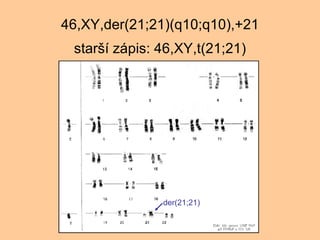 46,XY,der(21;21)(q10;q10),+21 star? zpis: 46,XY,t(21;21) der(21;21) 