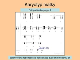 Karyotyp matky balancovan robertsonsk translokace dvou chromozom? 21 Fotografie (karyotyp) 7 der(21;21) 